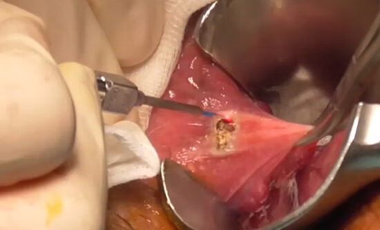 laser piles surgery in kolkata