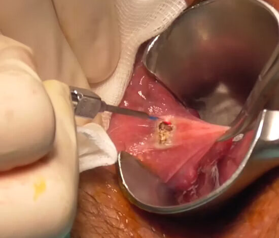 laser piles surgery in kolkata laser piles surgery in kolkata